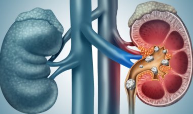 Kidney stones - self-care